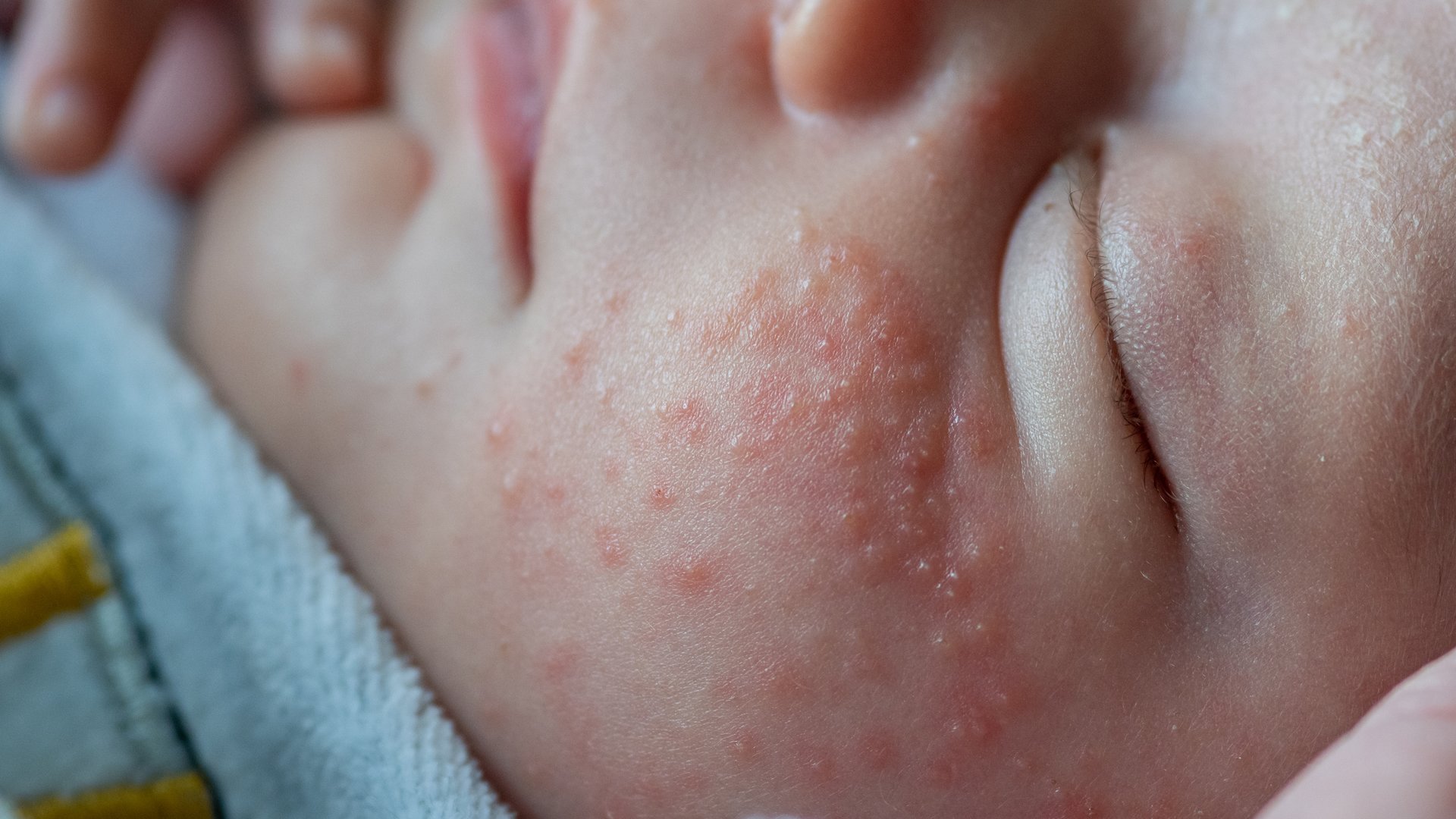 Babyakne: Wie behandele ich sie richtig? Hier sind die Antworten