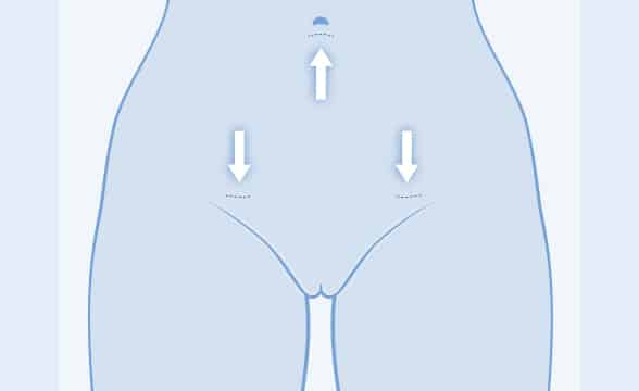 schwanger trotz sterilisation